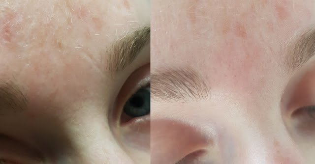 avant-apres-serum-typology